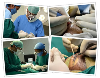 FUE hair transplant Treatment